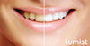Lumist Advanced Teeth Whitening Strips (FB)